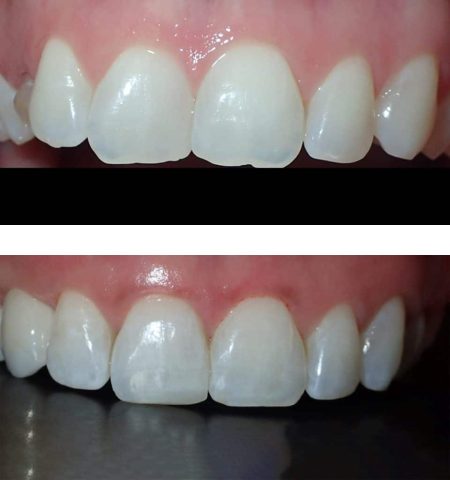 teeth-1