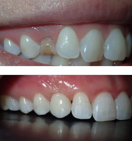 teeth-2